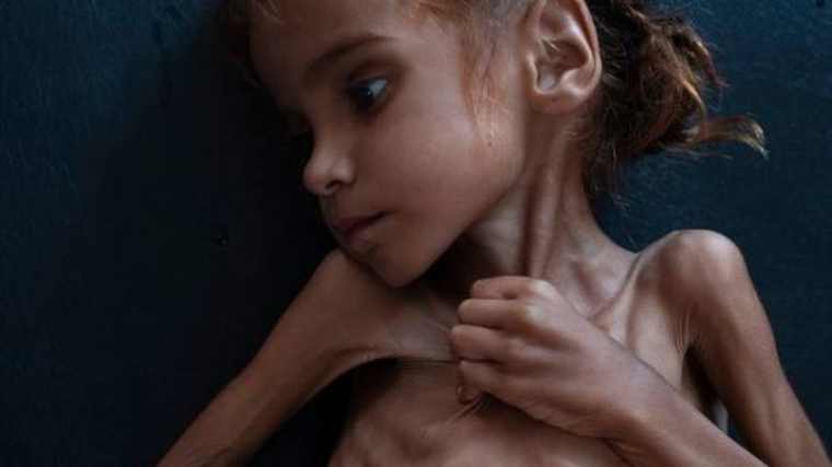 Πέθανε το 7χρονο κοριτσάκι που αναδείχθηκε σύμβολο του λιμού στην Υεμένη