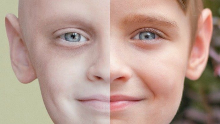 Ο παιδικός καρκίνος καταστρέφει εκατομμύρια χρόνια υγιούς ζωής