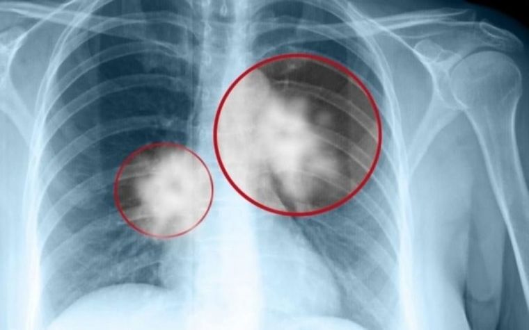 Ασφαλή τα εμβόλια Covid-19 στους ασθενείς με καρκίνο των πνευμόνων