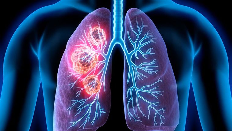 Καρκίνος του πνεύμονα: Μην Περιμένεις!