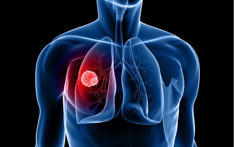 Έλεγχο για τον Καρκίνο του Πνεύμονα προτείνουν 55 ειδικοί επιστήμονες