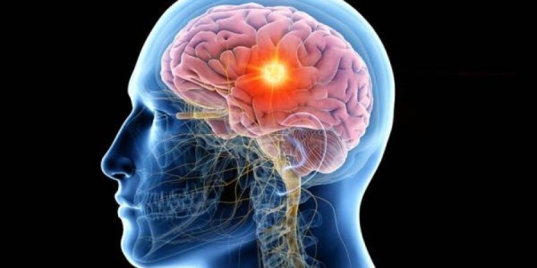 Τεχνική βαθιάς εγκεφαλικής διέγερσης αποκαθιστά λειτουργίες σε ασθενείς με εγκεφαλική βλάβη